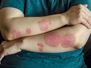 सोरायसिस हाेने पर क्या खाएं और किन चीजाें से करें परहेज? डायटीशियन से जानें डाइट चार्ट